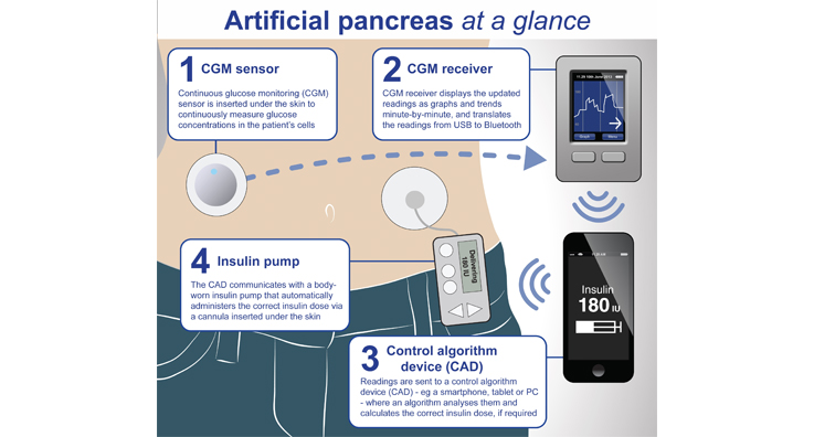 Artificial Pancreas Deemed Safe For Hospitalized Patient Use Drug Delivery Business 9542