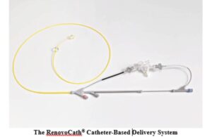 RenovoRx RenovoCath catheter-based delivery system (1)